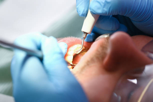 Best Chipped Tooth Repair Near Me  in Broadview Park, FL
