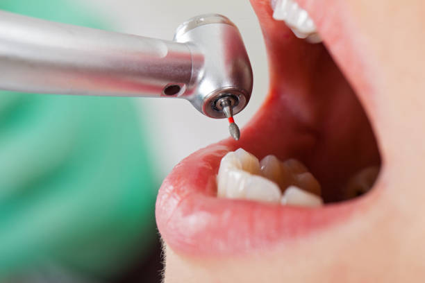 Best Knocked-Out Tooth Emergency  in Broadview Park, FL
